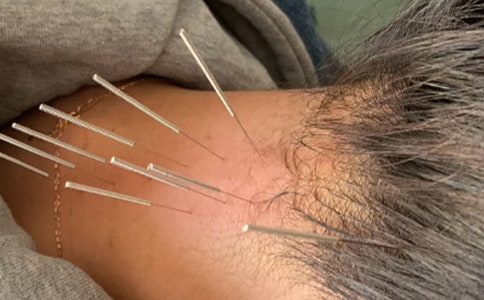 针灸科心得体会